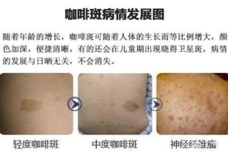 算命胎记