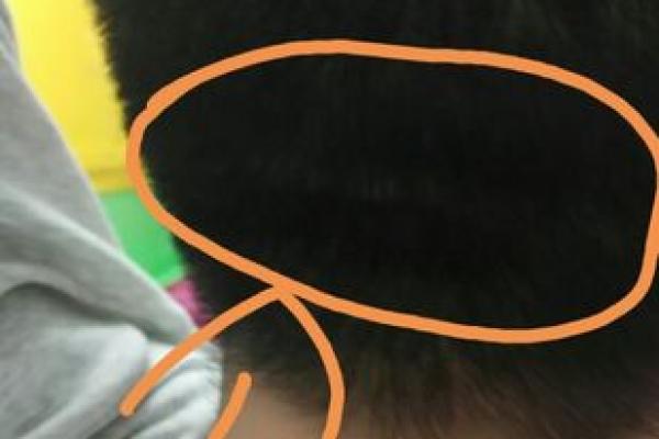 后脑勺有三条竖杠 后脑勺头皮三条竖纹算命