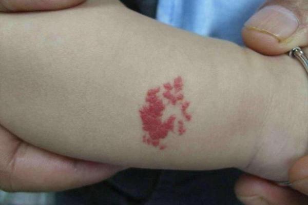 据脖子上胎记算命，有什么说法