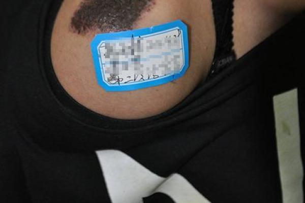 黑色胎记算命分析