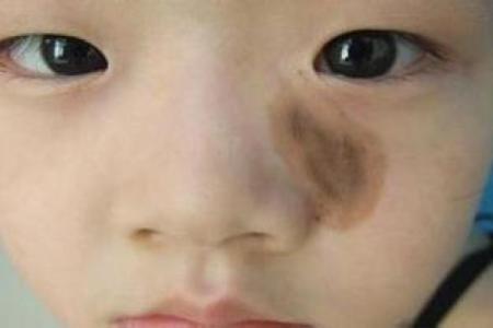 人体胎记算命的解释分析