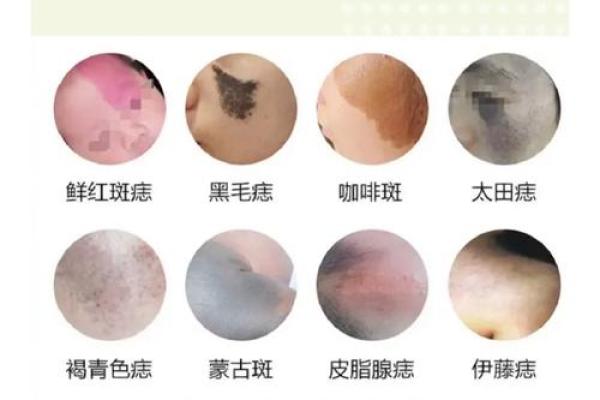 眼睛上的胎记算命分析