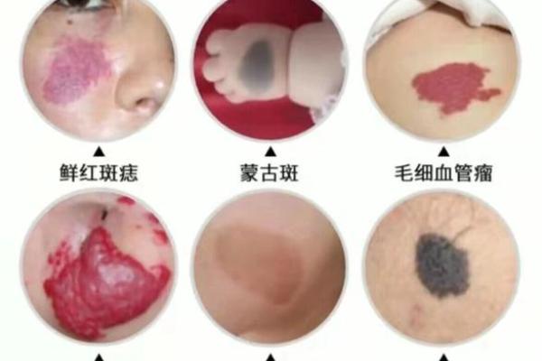 胎记算命图解：什么是红胎记？